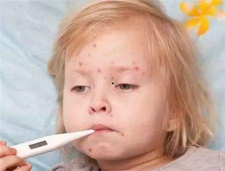 成人水痘自测视频大全,快速识别症状，守护健康